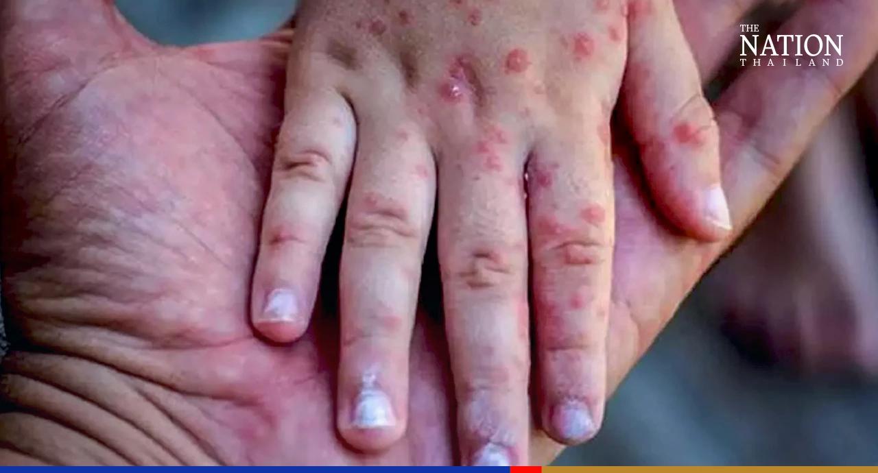 Doc offers advice on protection from monkeypox